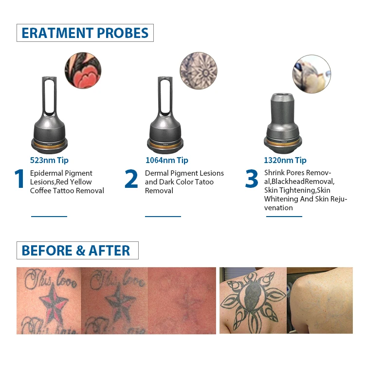 2025 Professional Wholesale Price Q-switch Nd Yag Portable Laser Tattoo Removal Machine nd yag laser for sale