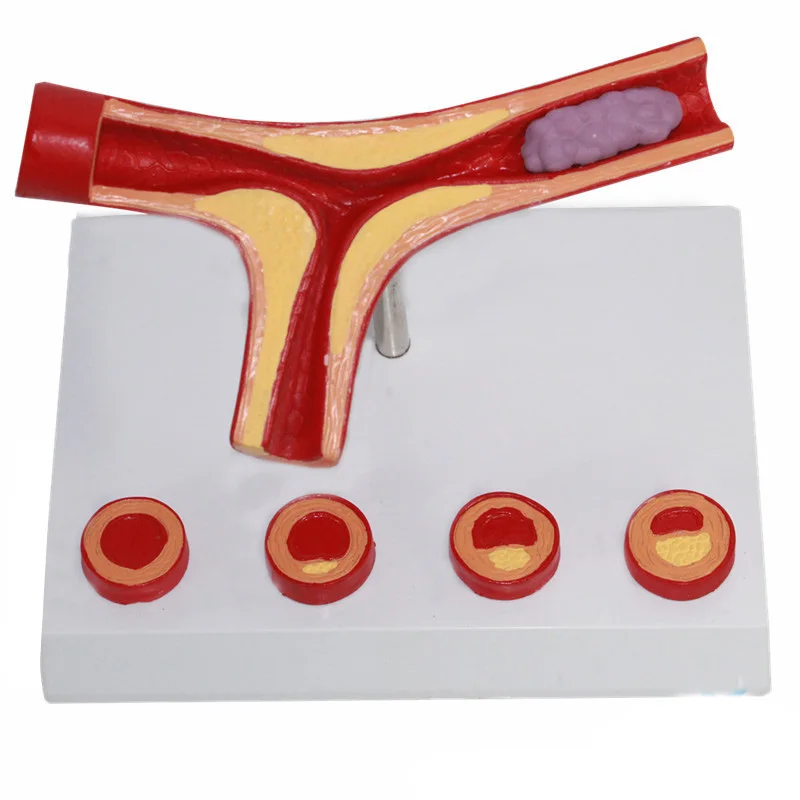Medical school teaching Blood vessel enlargement model Observation of lesions