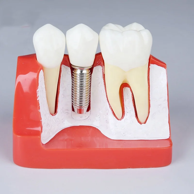 Dental Teeth Caries Model Removable, Model Teeth for Dental Education Supplies, Tooth Pathology Display
