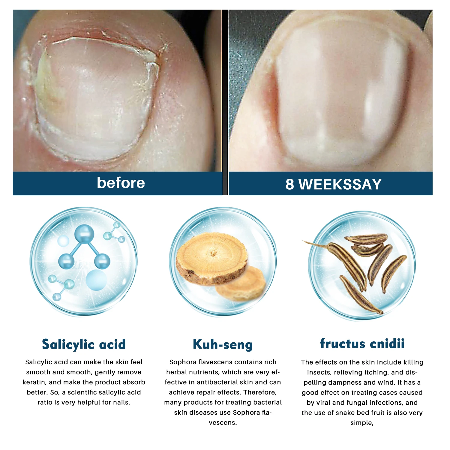 Lanthome Nail Fungus Removal Cream Onychomycosis Fungal Treatment Paronychia Anti Infection Feet Toe Fungal Care Ointment