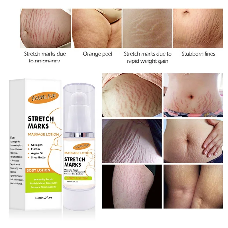 40%Off In Stock Upgraded Private Label Best Skin Repair Treatment Pregnancy Scars Remover Anti Stretch Marks Removal Cream