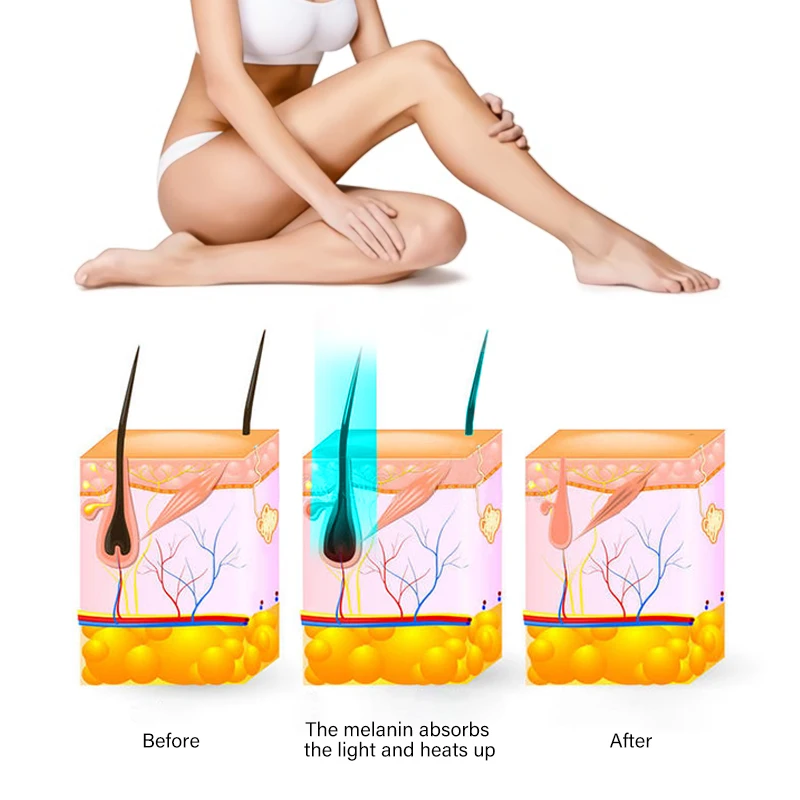 Removal Device Ice Cooling Ipl Hair Removal Professional Home Use Hair Removal Ipl Device