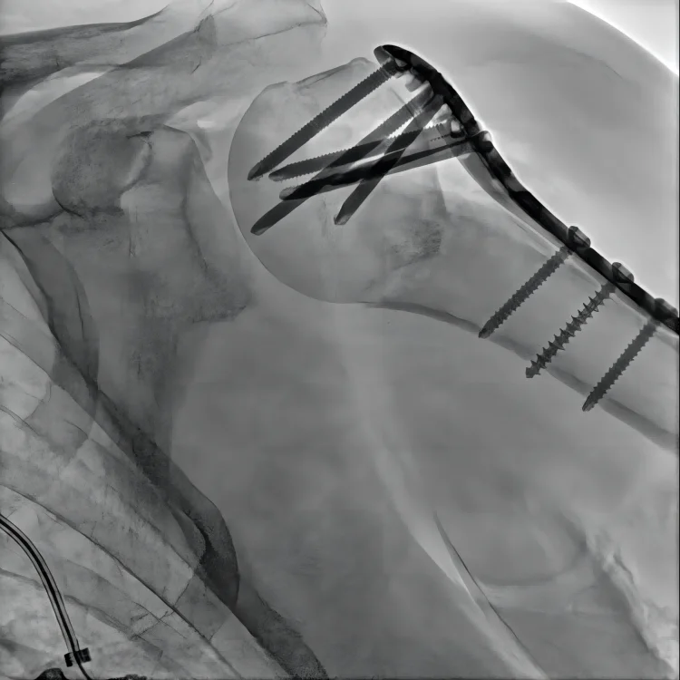 Dual-focus mobile fluoroscopy c arm x ray medical machines