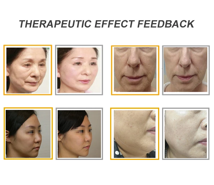 Portable 7d Hifu 4d 3 En 1 Face Lifting 12 Lines 8 Cartridges Mini Hifu Machine Anti Aging Korea 9d Smas 5d Hifu Machine Price