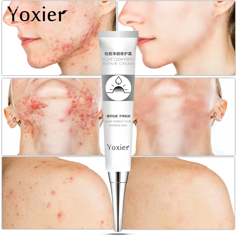 Skin Care Yoxier Remove Acne Pimples Cream Oil Control Acne Cream Face Acne Cream