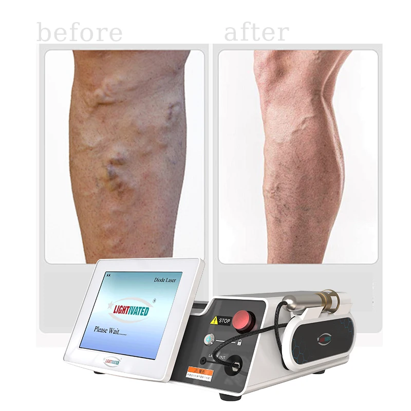 Endovascular diode laser ablation evlt 1470 endovenous laser for varicose veins device