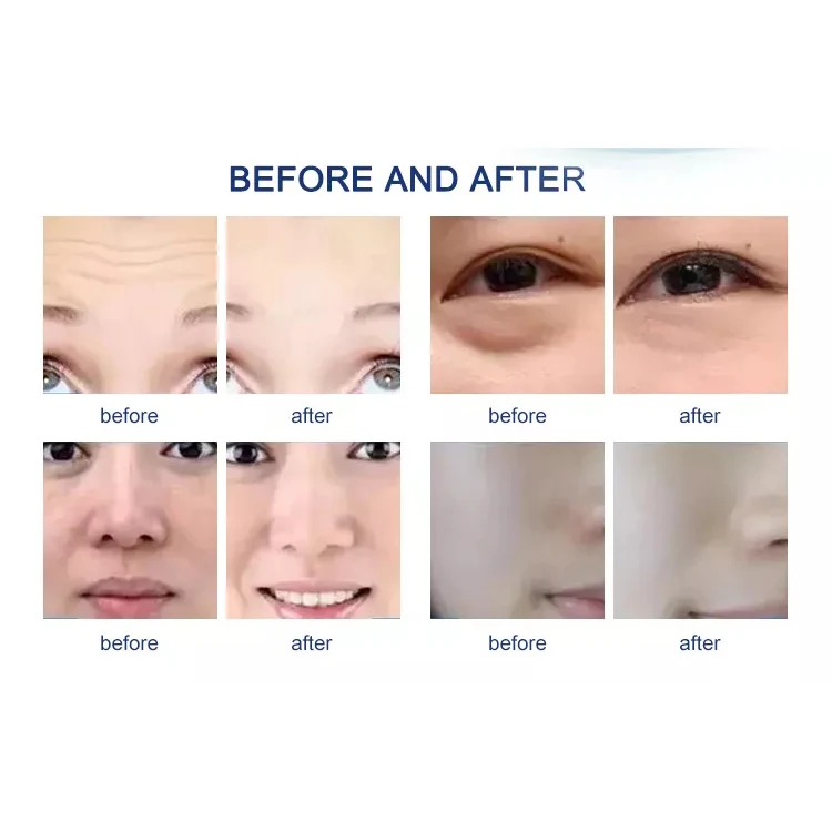 Newest Anti-aging Rf Ems Meso Nano Injector Gun Microcurrent Skin Rejuvenation No-needle Mesotherapy Device For Face