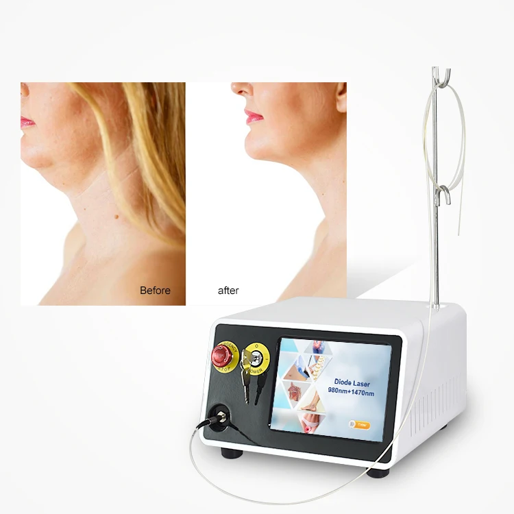 2024 Hot Sell High Quality Powerful Facial 980nm 1470nm Diode Laser Liposuction Machine