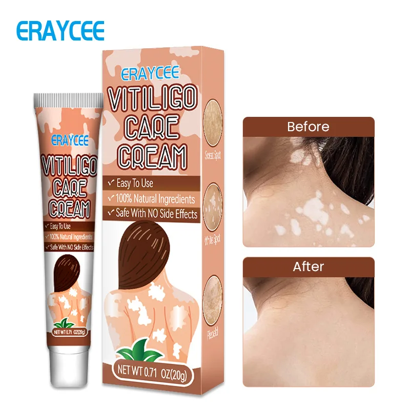 Vitiligo Safe and Effective Treatment Cream White Spot Ointment Flower Spot Sweat Purpura Skin Topical Ointment