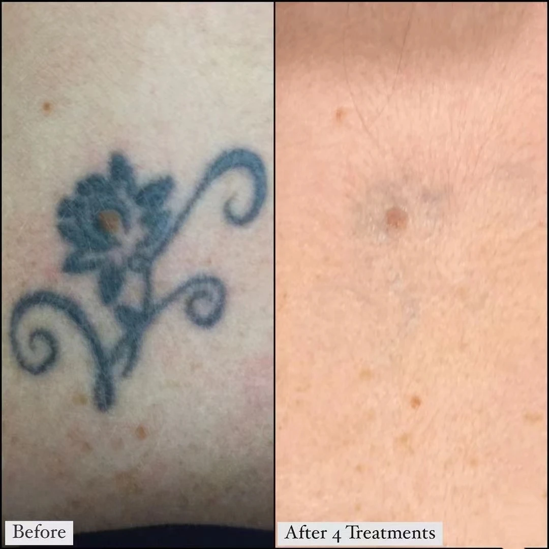 Sincoheren 1064 nm 532nm Q Switch Nd Yag Laser Tattoo Removal Aesthetic Technology Equipment for Medical Clinic