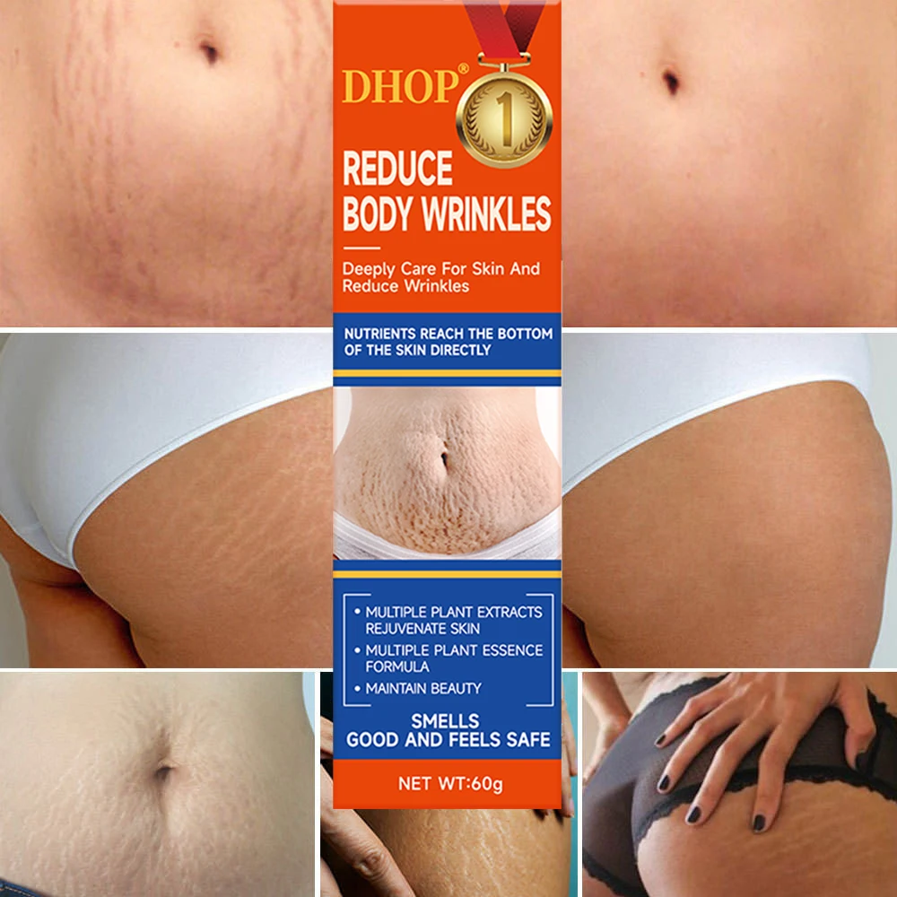 Improve Skin Relaxation Improve Skin Relaxation Stretch Marks Scar Removal Cream After Pregnancy Anti Stretch Mark Cream
