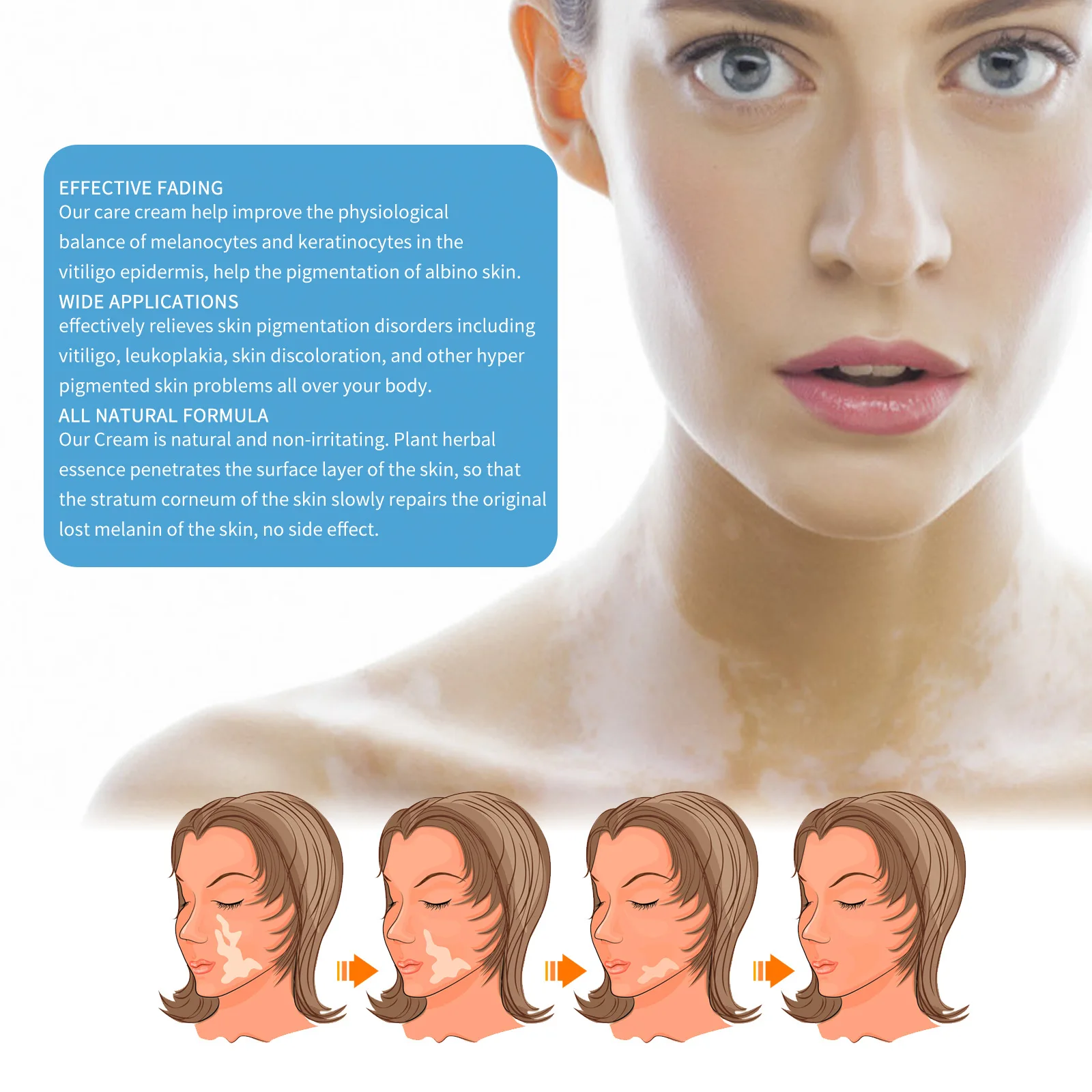 Body Care Fade Mottling Even Skin Tone And Lightened Body Spots Vitiligo Treatment Ointment