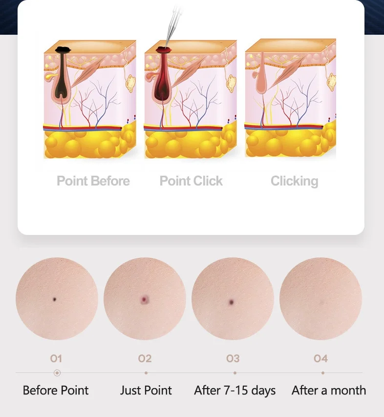 Laser Plasma Pen Skin Tag Tattoo Removal Device Tool Dark Spot Skin Tag Remover Pen