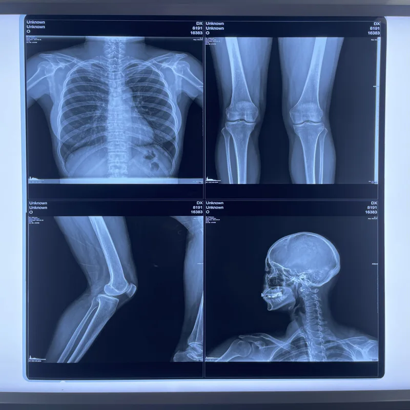 8*10 10*12 10*14 11*14 14*17 Medical Thermal Film Inkjet Dry Printer Use Medical Orthopedic X Ray Films