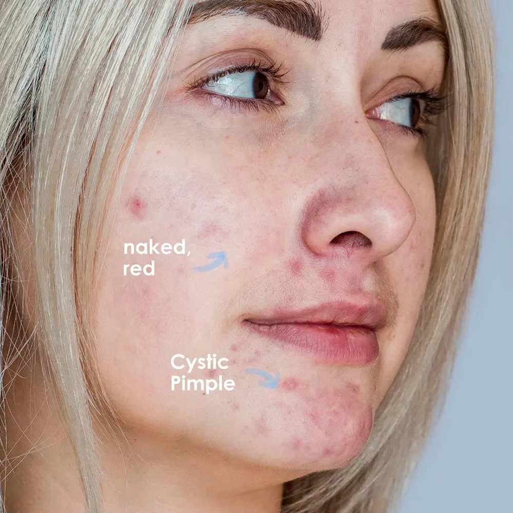 Post Blemish Color correcting Cream Replenish and Soothe Dry Skin After a Pimple Pops Vegan Friendly Formula Rescue Balm