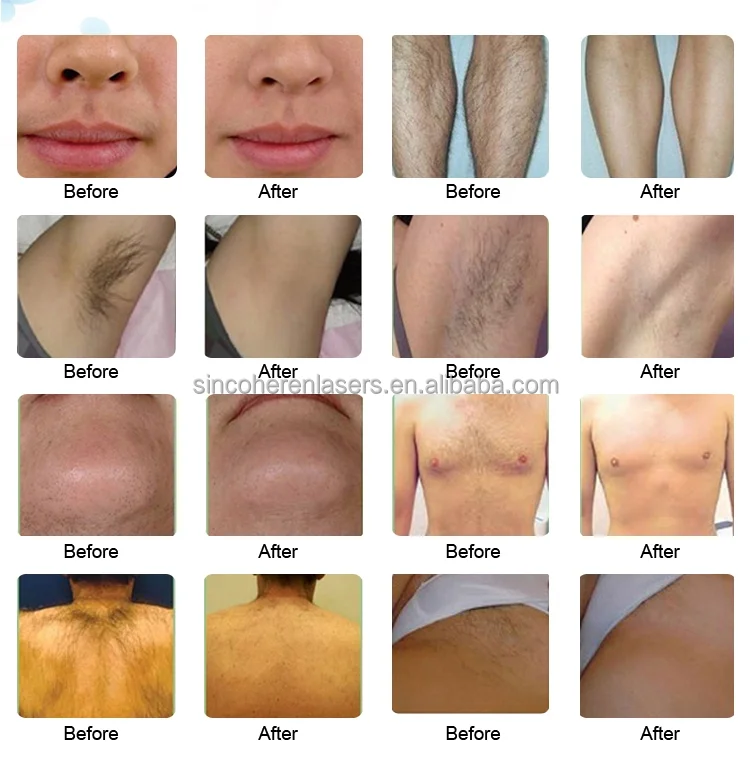 808 755 1064 Diode Laser Hair Removal Custom New Design Professional Laser Epilator Laser Hair Removal Handle