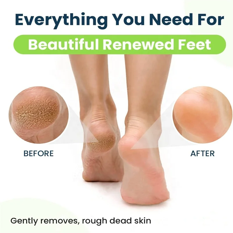 Urea 40% & Salicylic Acid 2% Intensive Moisturizing Cream Hand Foot Callus Remover Soften Exfoliate Dead Skin For Dark Elbows