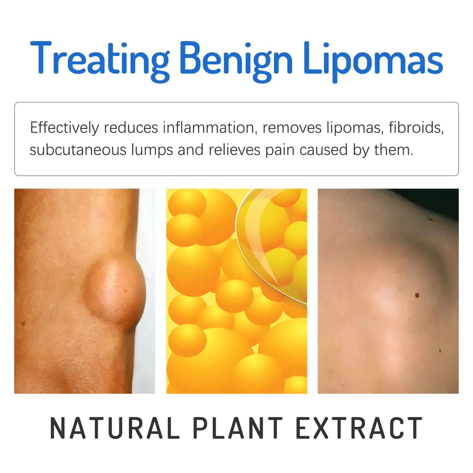 Hot Sale Free Shipping Lipoma Fat Removal Cream Good Price
