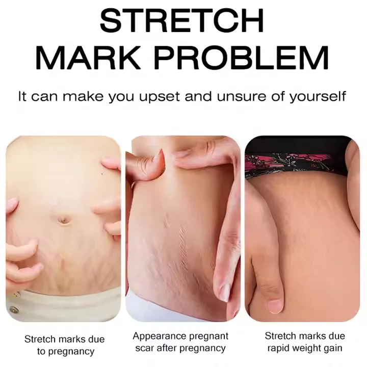Hot sale anti-stretch mark oil cream removal stretch marks black skin treatment skin repair Fade Stretch Marks Cream
