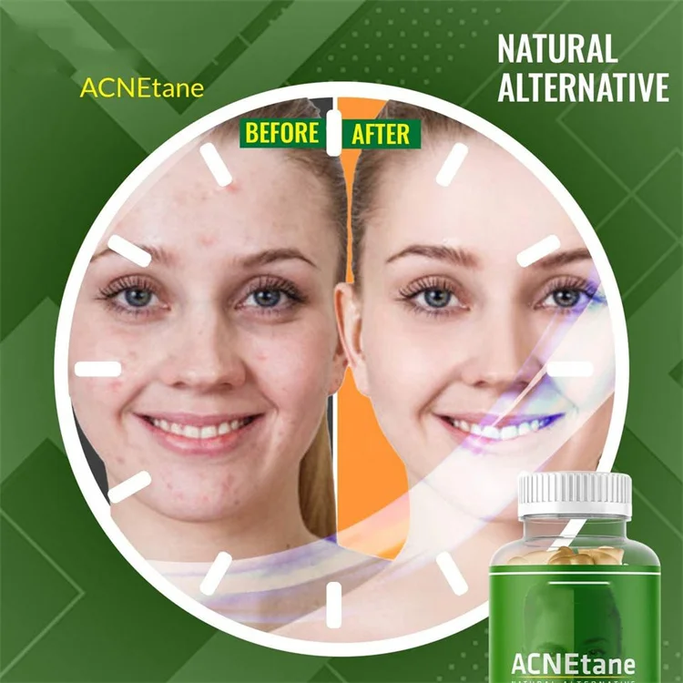 Customized Hormonal Skin Acne Vitamins and Supplements skin care gummies