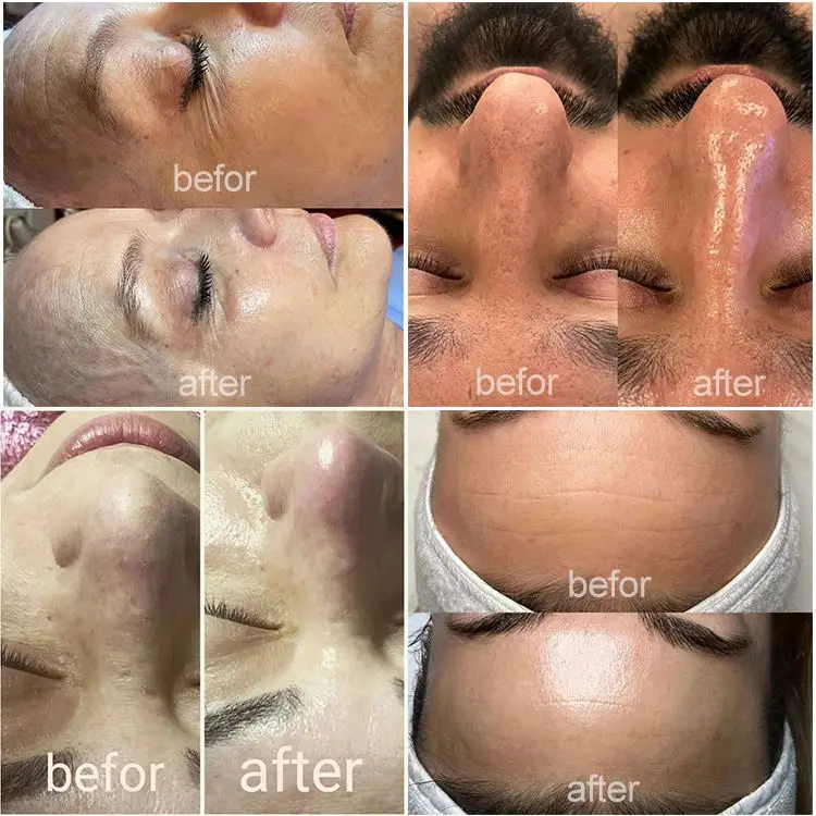 Hydra Benefits Facial New 2024 Ice Blue Hydro Solution Portable Products Cleaning & Oxygen Ems Tips Microdermabrasion Kit Pen