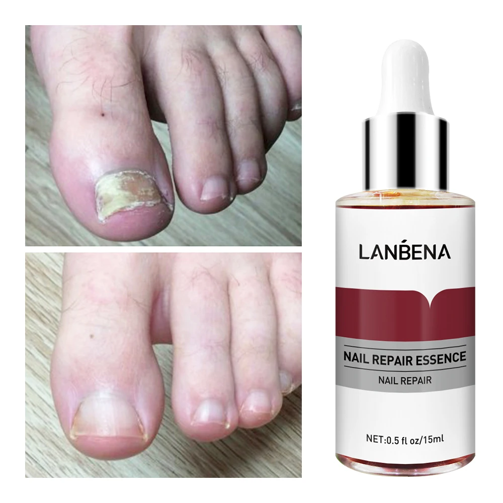 LANBENA Private Label Nail Fungal Treatment Serum Nail Care Repairing Nourishing Essence