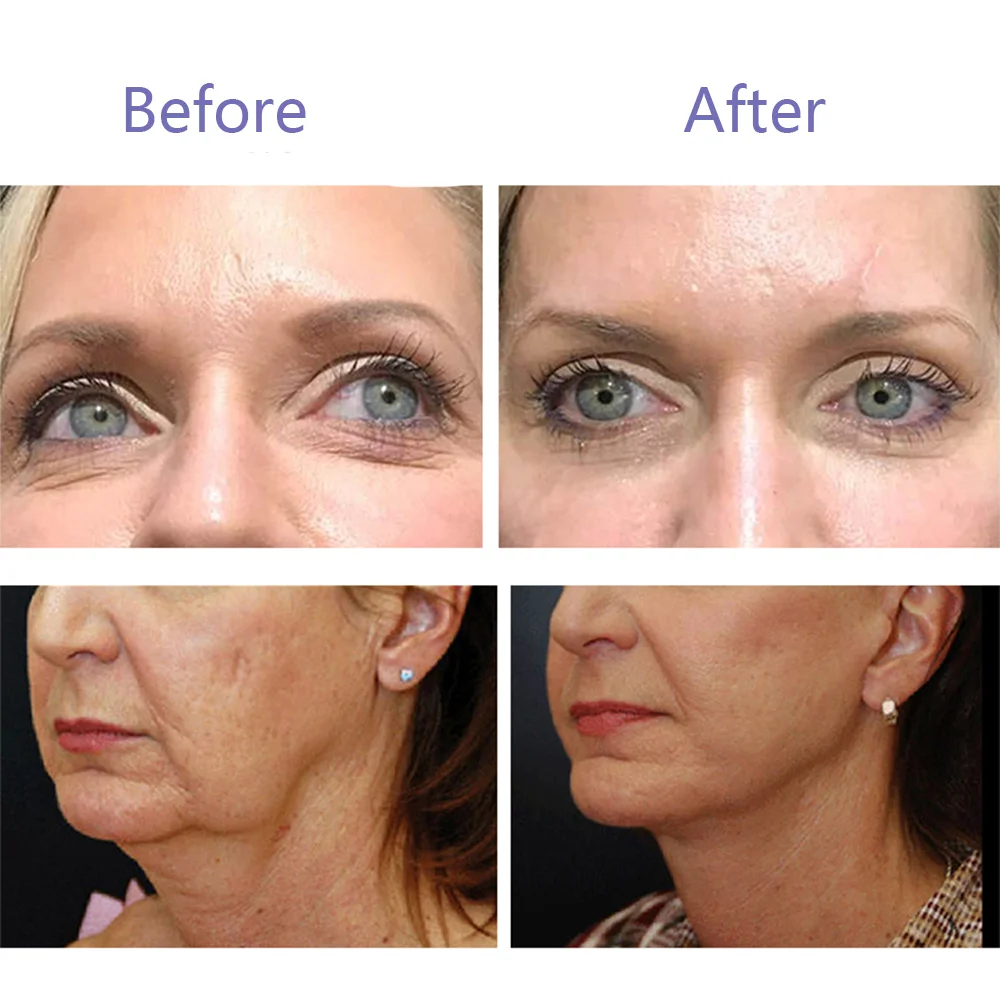 Wholesale Facial Absorbable Sharp Pdo Thread Lifting Cog Double Needle Skin Lifting Pdo Mono Thread Korea Paypal PCL PLLA