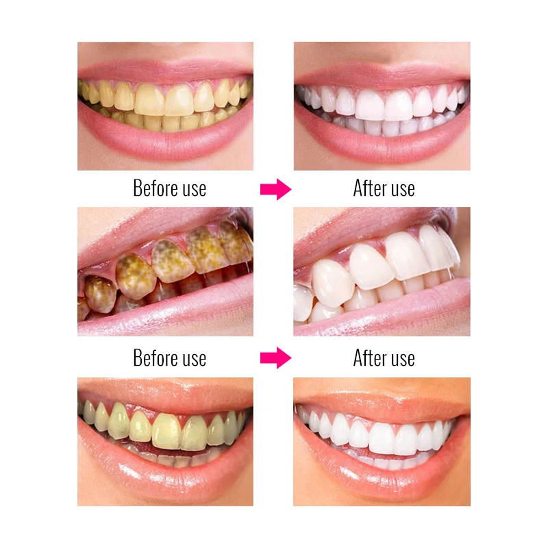 OMY LADY  March Expo 2022 Hot Selling  Teeth Whitening in Office and Brightenning Magic Non-toxic Teeth Whitening