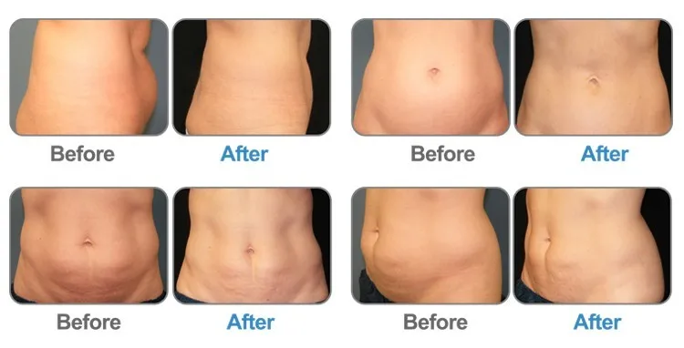 
360 Degree 5 handles chin applicator machine Cryotherapy beauty equipment 