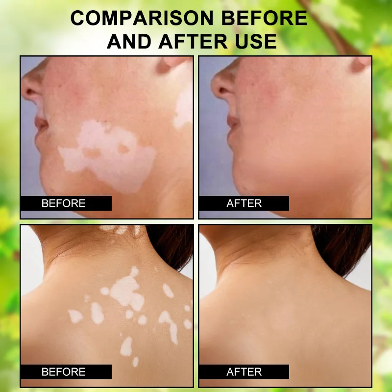 HBESTY Effectively Remove Vitiligo Ointment Remove Ringworm White Spot and Vitiligo Skin Care Product