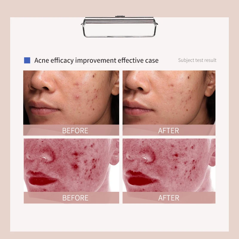 whitening acne scar remove skin care with Moisturizing Acne Scar Removal Anti Acne Whitening Face remove skin care