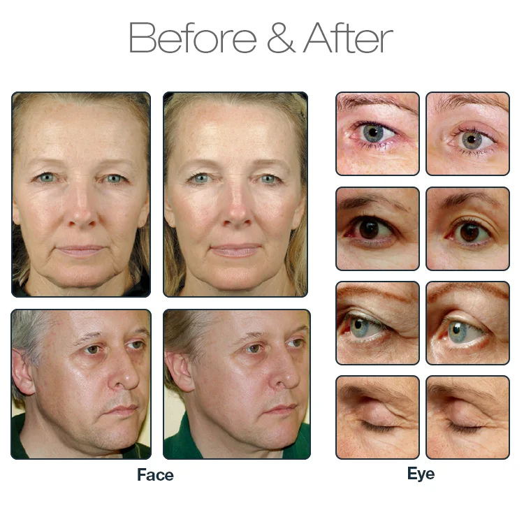 Need-free fractional radio frequency machine for eye face and body 5mhz RF for facial skin tightening eye wrinkle removal