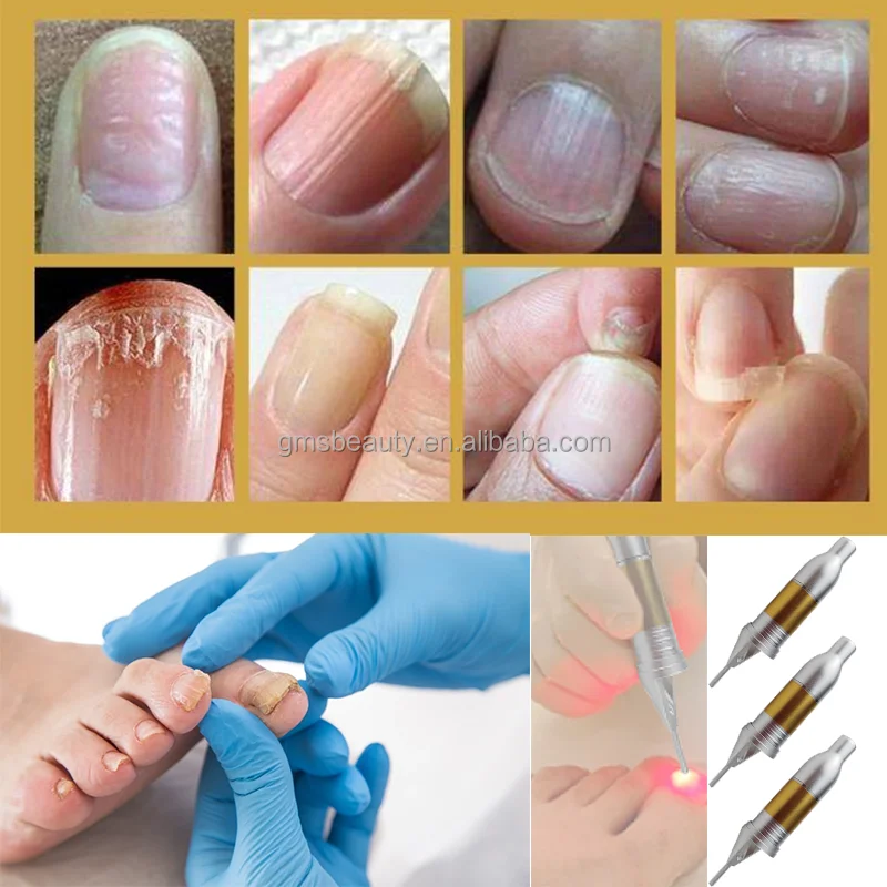 New invention product 980nm 905nm laser toenail nail fungus treatment machine