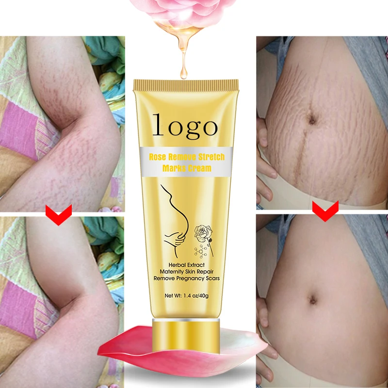 Pregnancy Stretch Mark Removal Cream Scar Stretch Marks Removal Gel