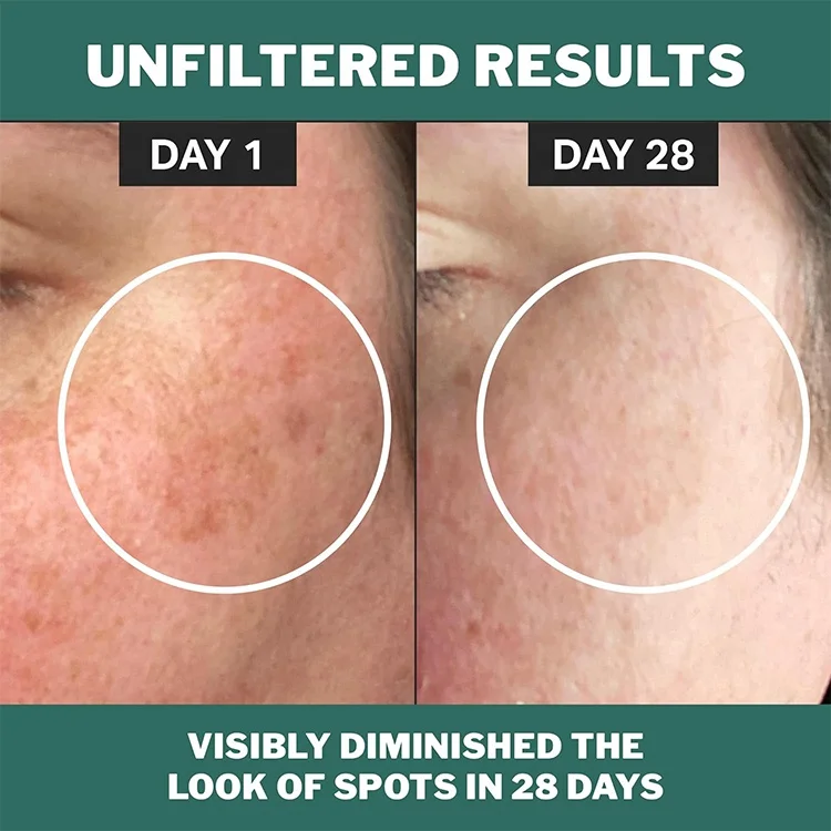 Chlorophyll Discoloration Serum 1% Alpha Arbutin Licorice Root Reduced Redness Improves Uv Damage Lifting Serum Face Care
