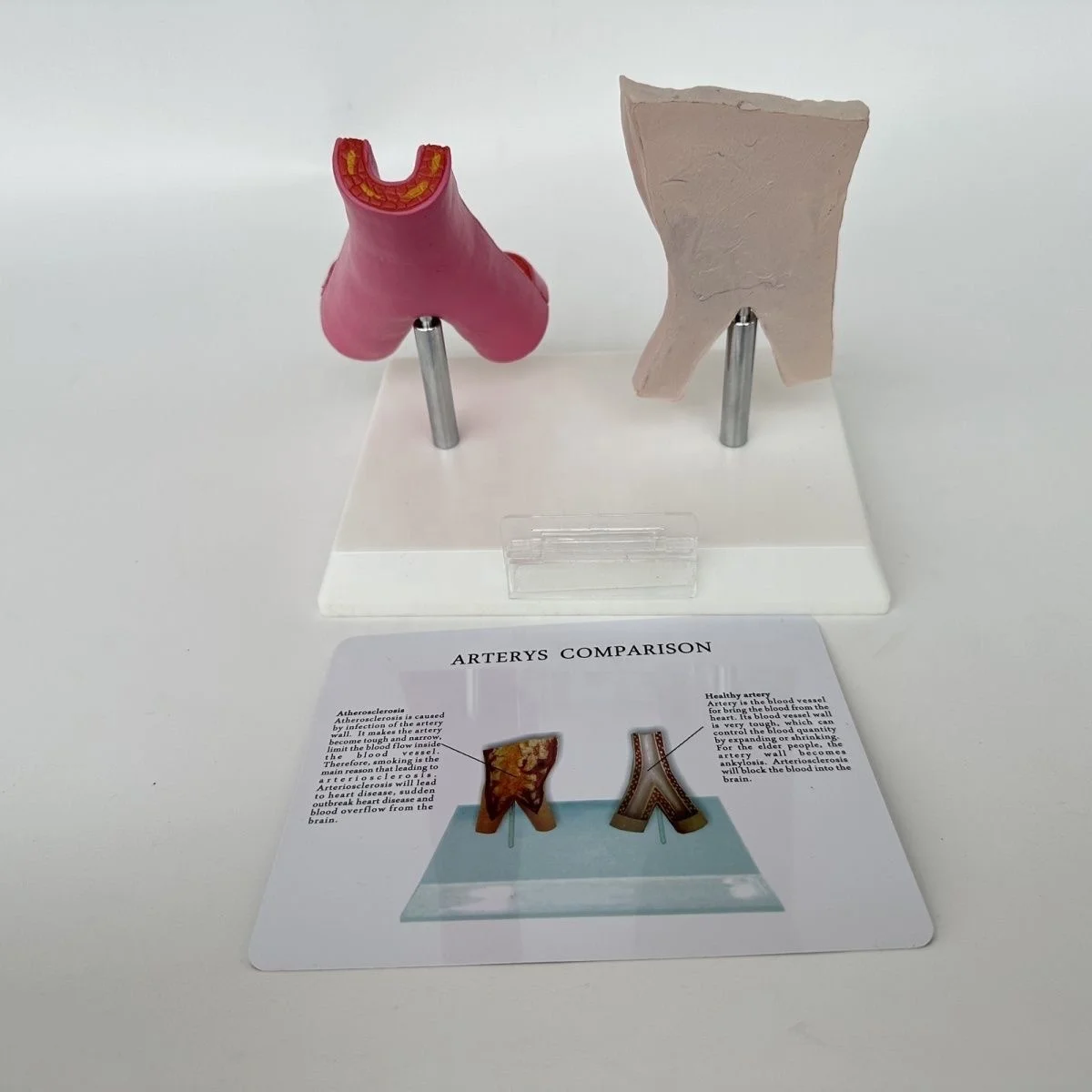 Medical Sciences Comparison Model Between Smoking Blood Vessels and Normal Blood Vessels  Artery Pathology Model