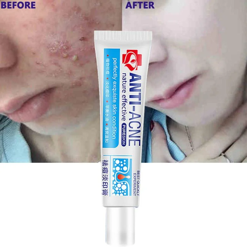 Effective Herbal Shrink Pores Moisturizing Whitening Remove Pimple Cream Face Anti Acne Removal Cream