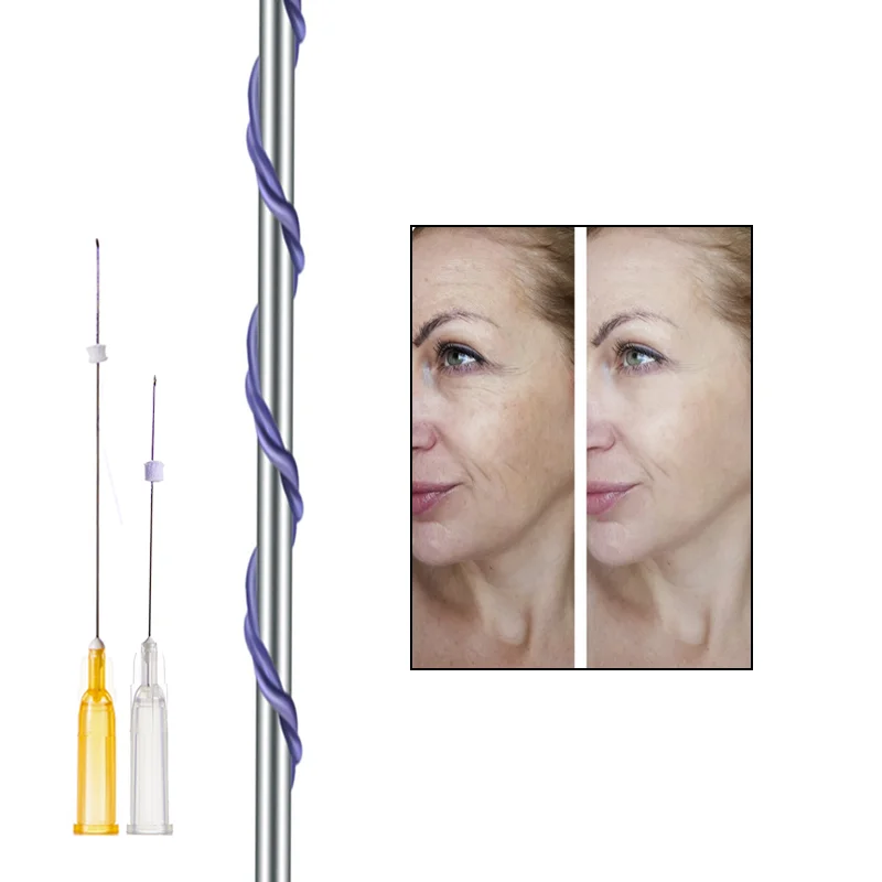 2023 skin beauty firming young suture material hot sale lasts a long time tornado tornado screw PDO thread from Korea