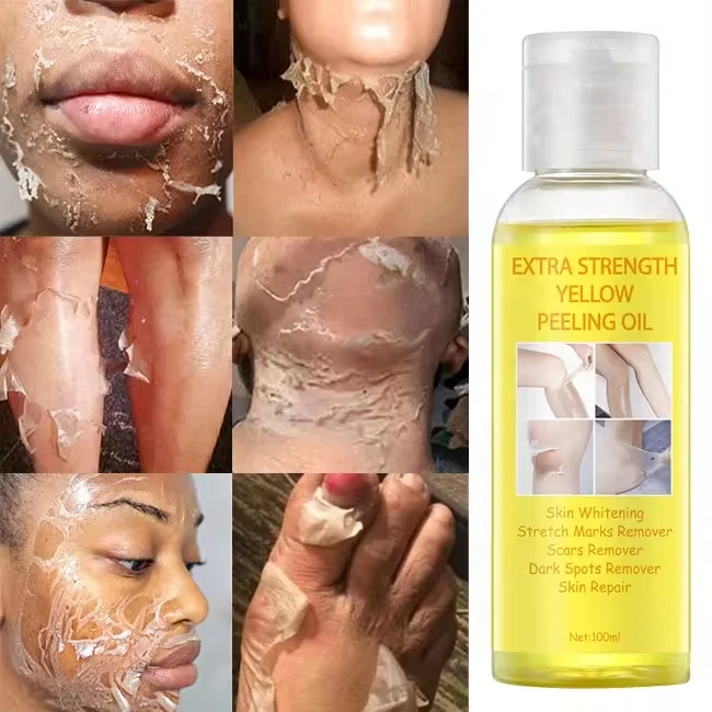 HOT Sale OEM Super Strength Yellow Peeling Oil Black Skin Strong Bleaching Oil Skin Remover African Whitening Yellow Peeling Oil