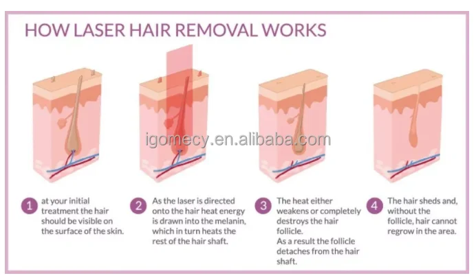 Best-selling-808nm-1064nm-diode-laser-hair-removal-machine-painless-spots-treatment-machine-K16-808