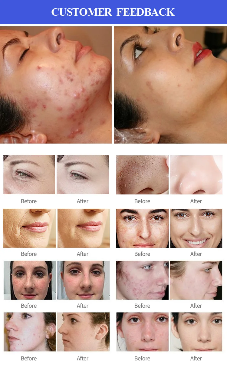 14 In 1 Hydra Water Dermabrasion Rf Bio Lifting Spa Facial Machine/hydro Aqua Beauty Salon Equipment / High Quality Hydra Water Dermabrasion / Hydro Aqua Beauty / Water Dermabrasion