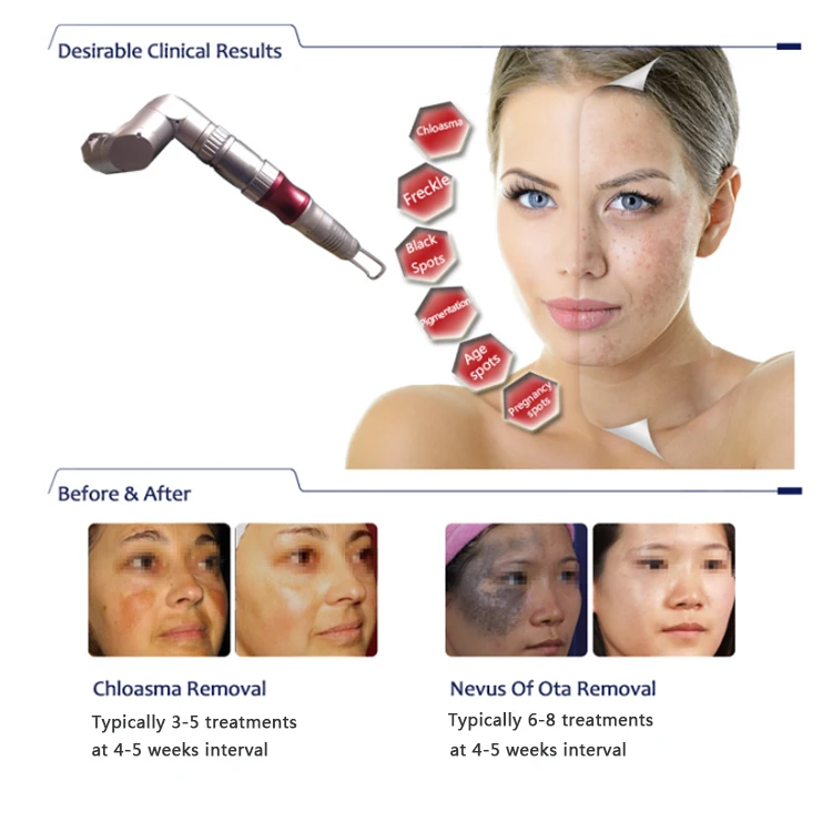 KES Personal remove eyebrow embroidery tattoo machine/q-switched nd.yag laser machine/remove acne