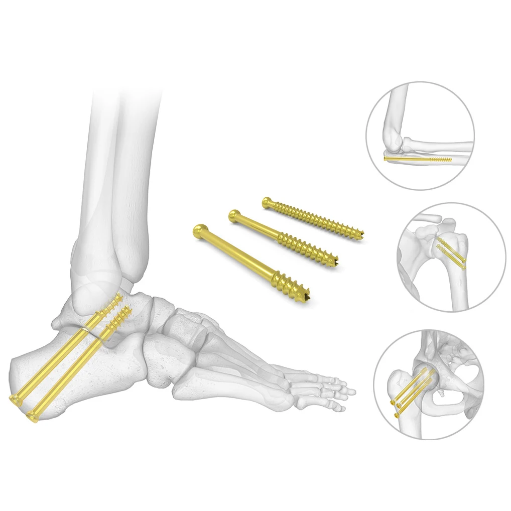 CANWELL  Medical Bone Screws Titanium 3.0 4.0 6.5 7.0 mm Herbert Screw Spine Cannulated Screw
