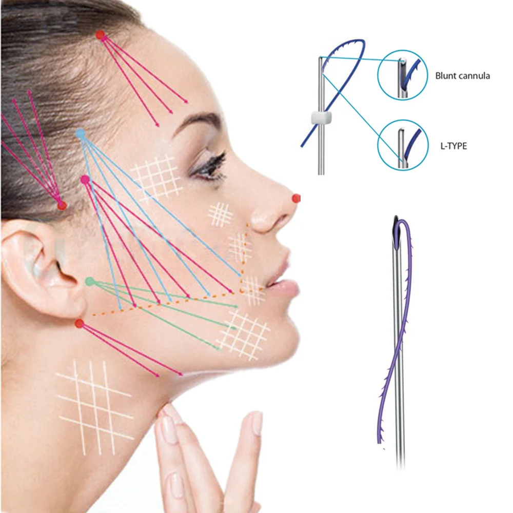 
Lowest price ever Mono pdo eye threads sale 30g 25mm fio de pdo thread Korea pdo thread for The mouth 