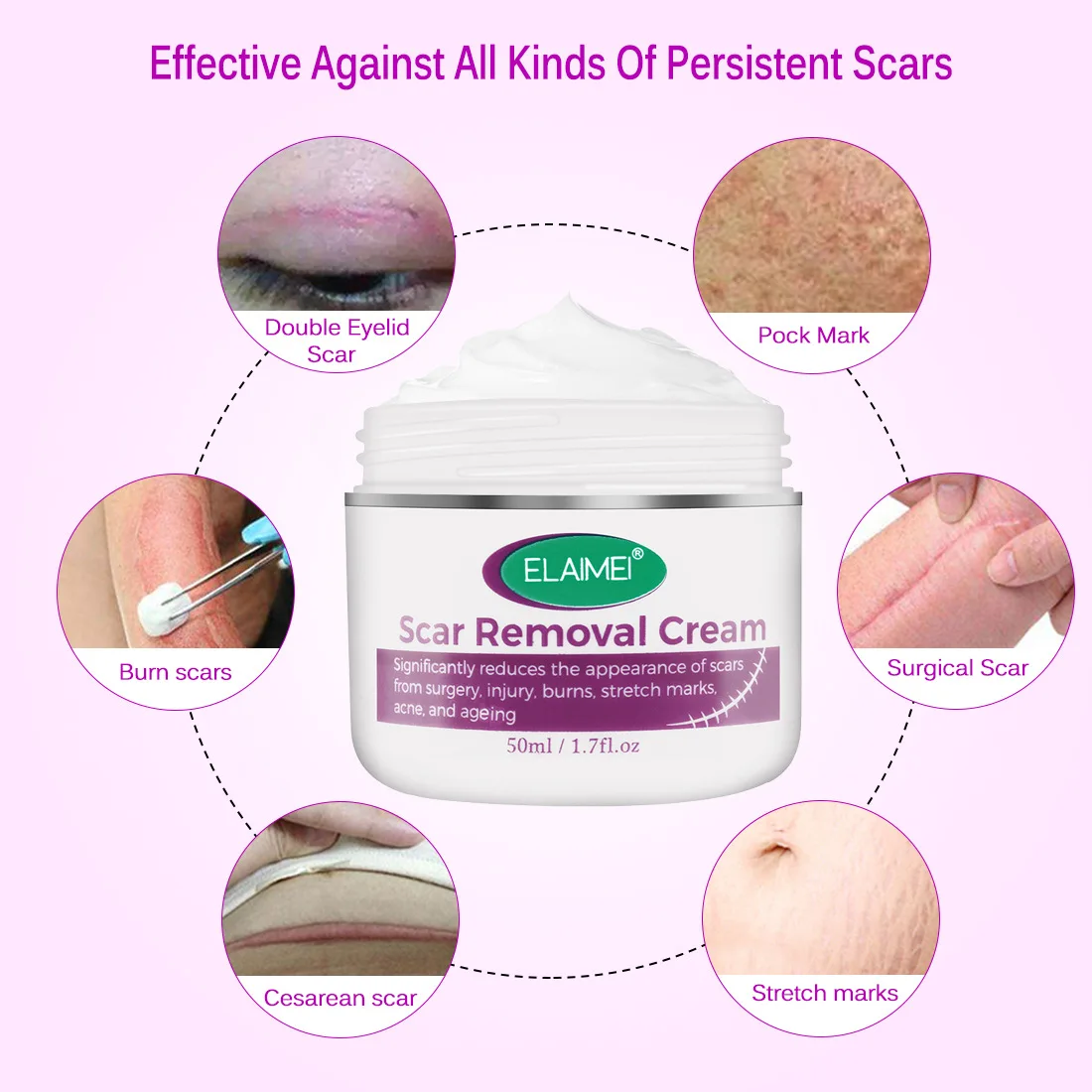ELAIMEI Scar Removal Cream Effectively Prevents Scar Aproliferation After Surgery