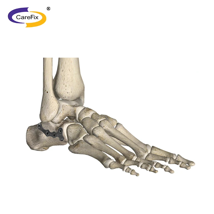 Straight Locking Mini Plate screw for foot ankle elbow fracture LCP meditech orthopedic implants