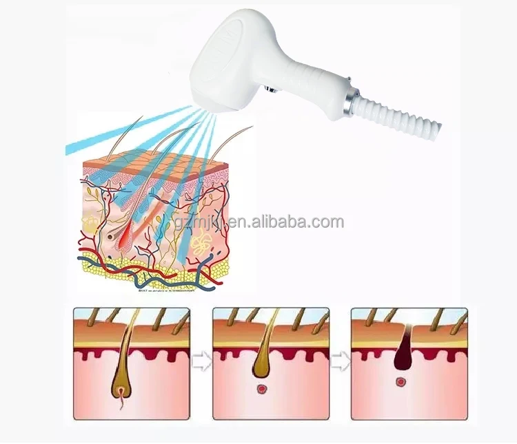 Alma Soprano Ice Titanium Diode Permanent 3 Waves  808 755 1064 nm Beauty Salon Machine Professional Portable Laser Hair Removal