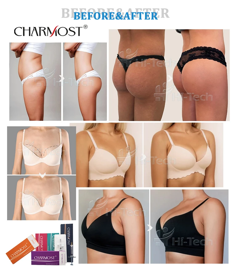 Charmost 10ml 20ml Hyaluronic Acid Dermal Filler Injection Increase Buttock Breast Enlargement Hydrogel Butt Injections For Sale