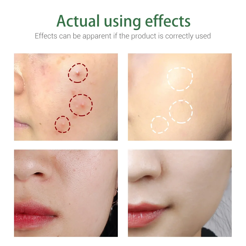 BREYLEE Tea Tree Oil Salicylic Acid Facial Cleanser Remove Acne Oil Control Facial Cleaning Cream Acne Treatment Facial Cleanser