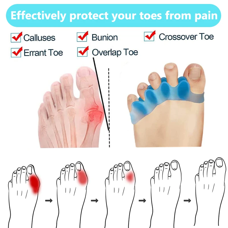 Preventing Rubbing Bunion Corrector Overlapping Hammer Toe Straightener Stretcher Soft Silicone Gel Toe Spacers for Bunions